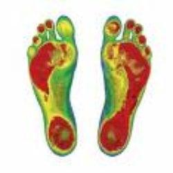 We can do a free painless 5 min scan to see if you have flat or collapsed arches in your feet causing your condition... or making it worse.