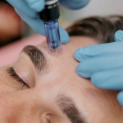 Microneedling