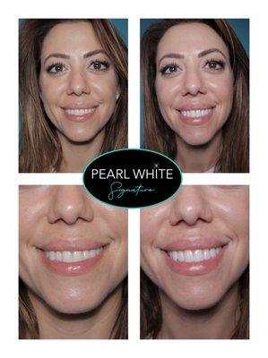 This is a part 2 of our Signature PLUS Laser Teeth Whitening Treatment. Fantastic results!