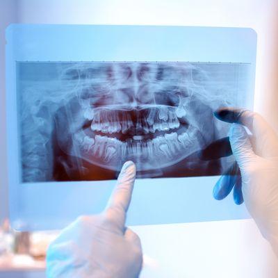 Close-up of advanced dental implant technology used at Elevation Center for Oral, Implant, and Facial Surgery, ensuring long-...