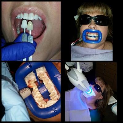 Zoom Whitening demo on our office manager Krista!