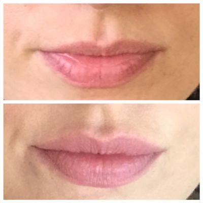 Natural-looking lip filler...look hydrated, not sausage-lipped