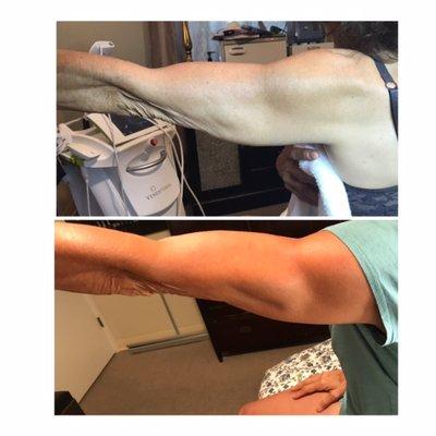 Body contouring arms 5 sessions in