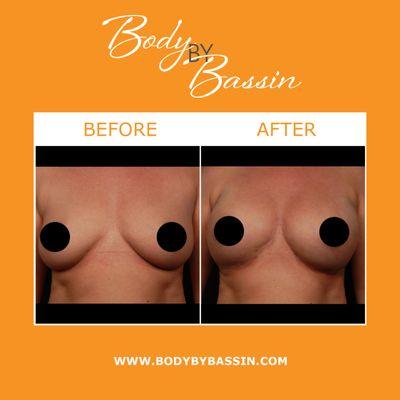 NaturalFill® breast enhancement uses the Aqualipo® process with fat transfer to provide long-lasting, natural-looking breast enhancements.