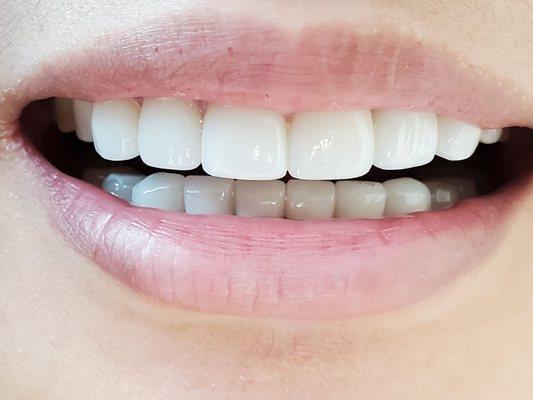 Smile makeover! 8 crowns and 6 veneers lifelike and natural looking