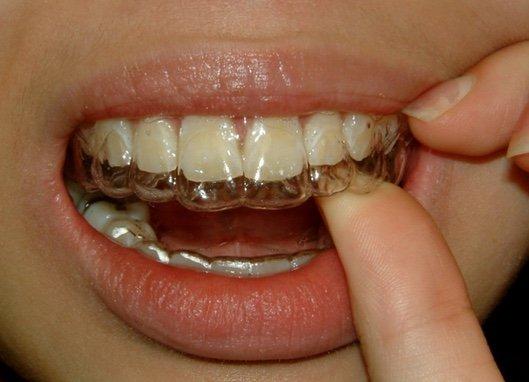 Call us at 972-947-2000 (Dallas) or 972-947-2200 (Allen) to see if invisible braces are right for you.  Transform your smile!