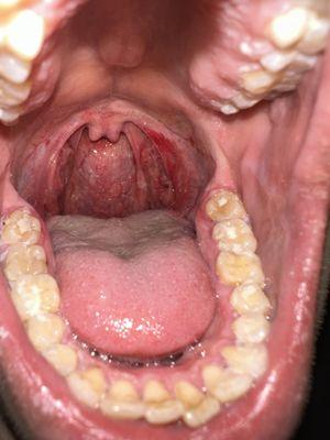 Scaling Root Planing (SRP/Deep Cleaning) with tonsil irritation