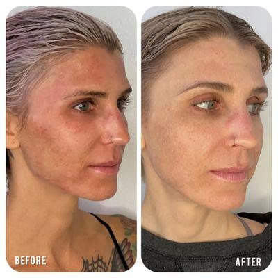 3 rounds microneedling with platelet rich plasma, and 3 VI Peels + medical grade skincare