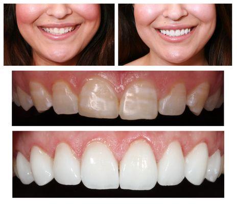 Eight Porcelain Veneers