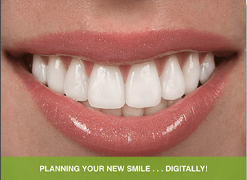 CEREC same-visit dentistry!  Digital all ceramic crowns!