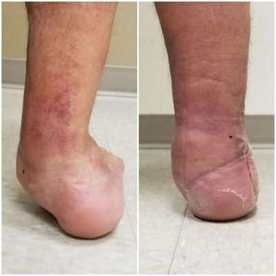 Ankle arthritis with deformity before and after