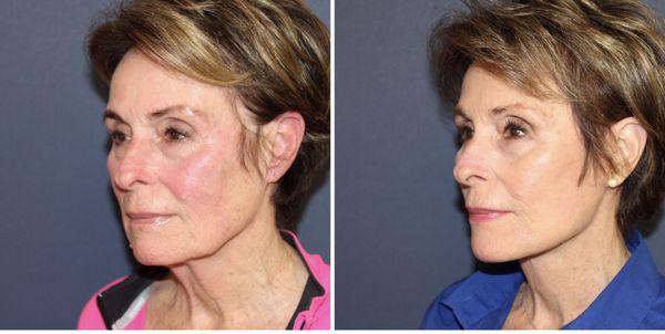 Before and after facelift