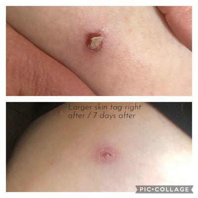 Right after treatment and 7 days after of large skin tag treatment with laser alternative.