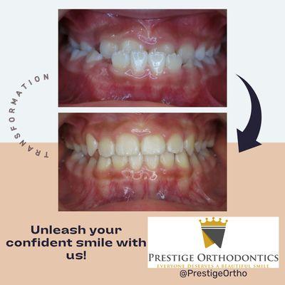 Phase I treatment for underbite