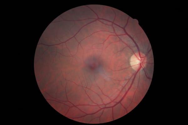 Our advanced Retinal Camera can show many eye diseases.