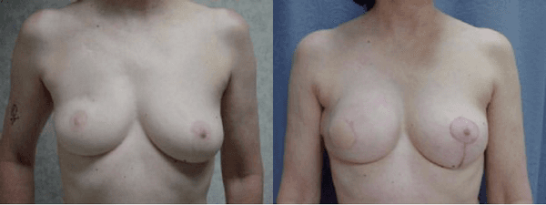 Breast Reconstruction