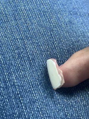 This is the left side of toenail of acrylic  All that acrylic was like burying my real toe nail and going thru my skin