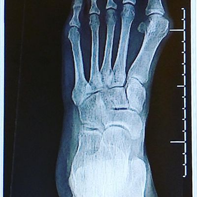 Left bunion before surgery