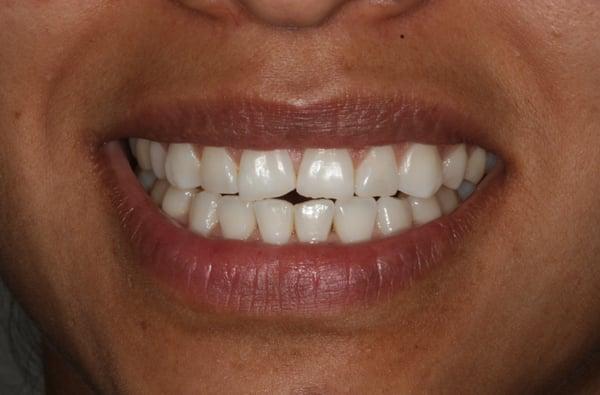 VENEERS before