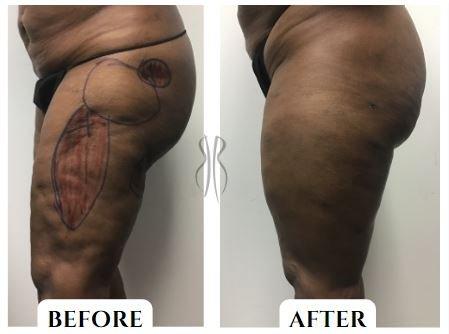 Before & After: Lipo correction of the outer thigh