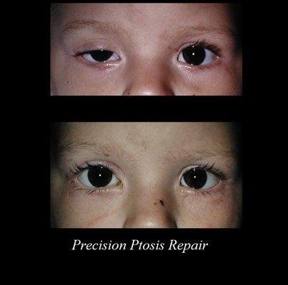 Precision microsurgical techniques for Ptosis Repair for children and adults.