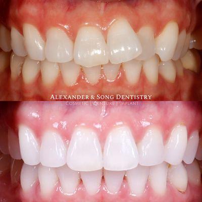 All natural teeth after an Invisalign treatment and minor bonding