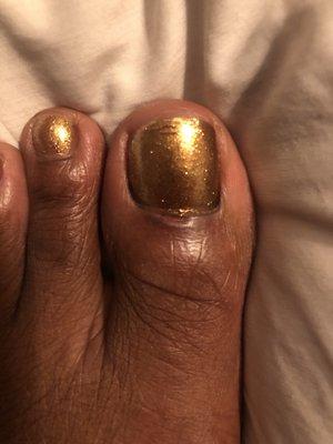 I couldn't look at my toe for hours because when it happened, it made me queasy. This is about 24 hours after so it started healing.