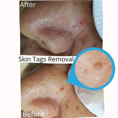 Skin tags removal