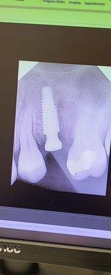 New way to place a dental implant