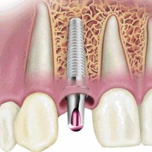 Dental Implants To Replace Missing or Broken Teeth