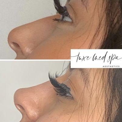 Non-Surgical Rhinoplasty (Nose Job) in Orlando, FL