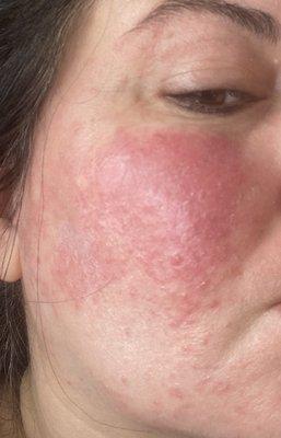 Rosacea flare up before taking Natren Healthy Trinity Probiotics