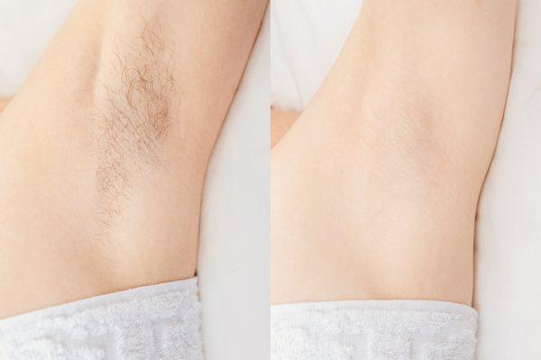 Before and after sugaring hair removal.