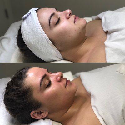 Before and In Progress Acne Scarring Treatment