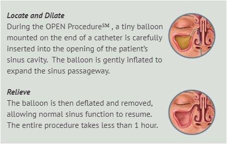 This is an example of our OPEN Procedure which works miracles for chronic sinus problems!