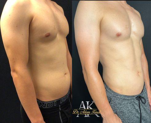 Lipo-etching for men