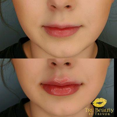 Before and After Lips