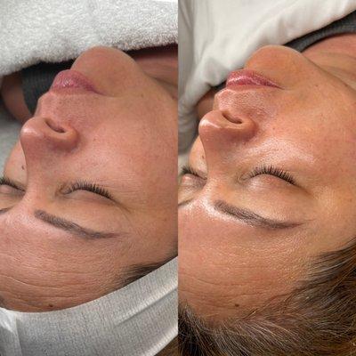 Hello Skin Signature Facial with Facial Cupping add on