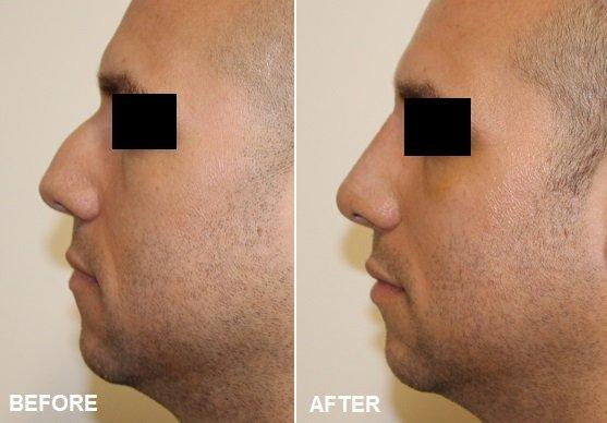 Before and After Septorhinoplasty performed by Dr. Albert Chow - 1 week post op