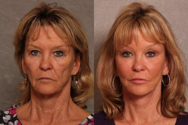 Refresher Facelift with Neck Lift, Lower Lid Blepharoplasty, Brow Lift, Fat Transfer to Cheeks, Lips, Nasolabial Folds, & Brow