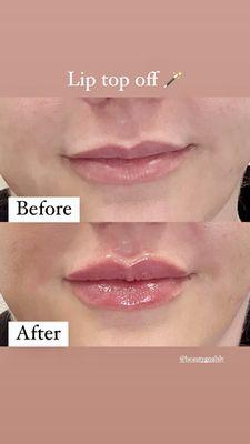 Lip filler