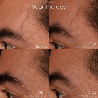 : Regenerative Scar Therapy with Platelet-Rich Fibrin Injections
: Before and Five Months After