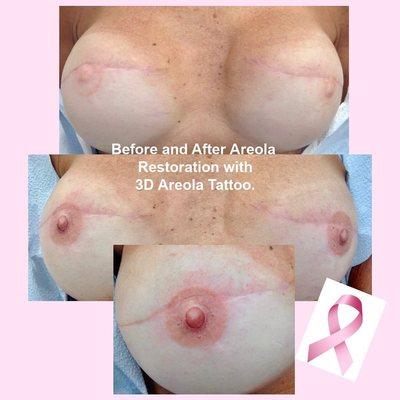 3D Areola restoration after breast cancer reconstruction.