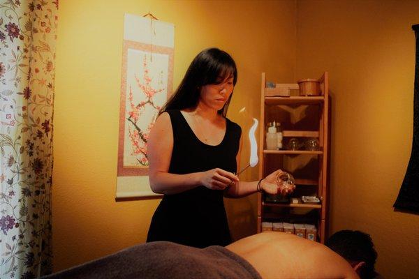 Cupping at the end of an Acupuncture Session