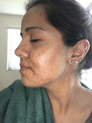 Her skin is on the way to being clear of acne after her 2nd treatment.