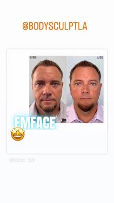 EMFACE