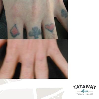 Hand tattoo completely removed