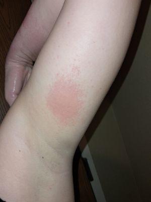 Rash from the pool that they claimed was well maintained.  It was worse after I left