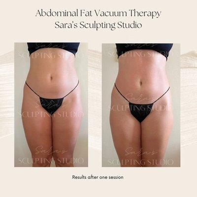 Abdominal vacuum therapy