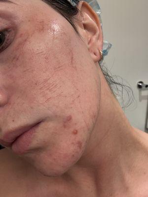 Again this is NOT normal microneedling from a trained professional.